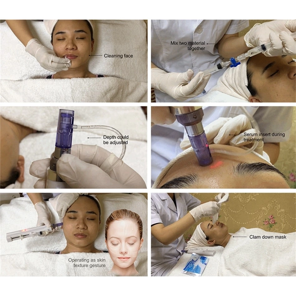 dr pen microneedling