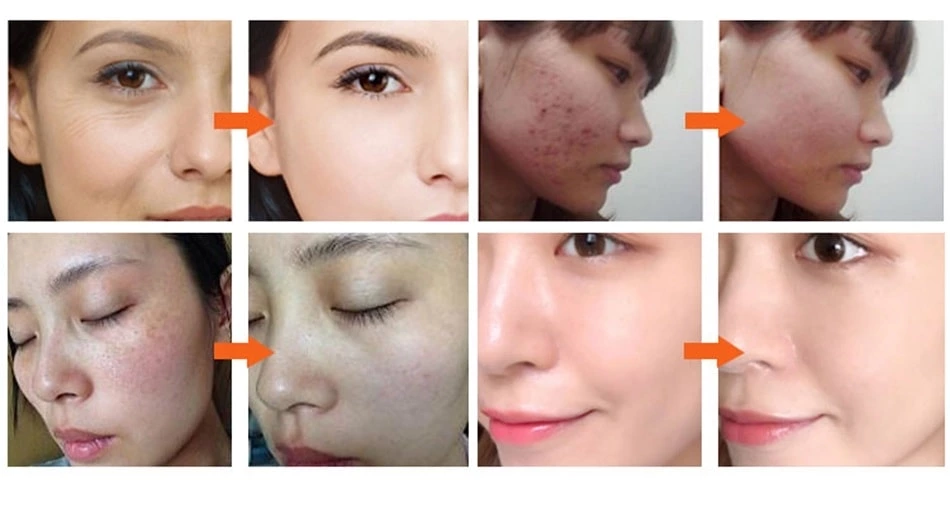 Led Light Therapy Face Mask Photon Instrument