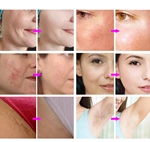 Skin Rejuvenation Skin Tightening Multifunctional Ipl Hair Removal Machine