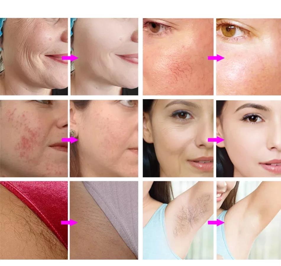 Skin Rejuvenation Skin Tightening Multifunctional Ipl Hair Removal Machine