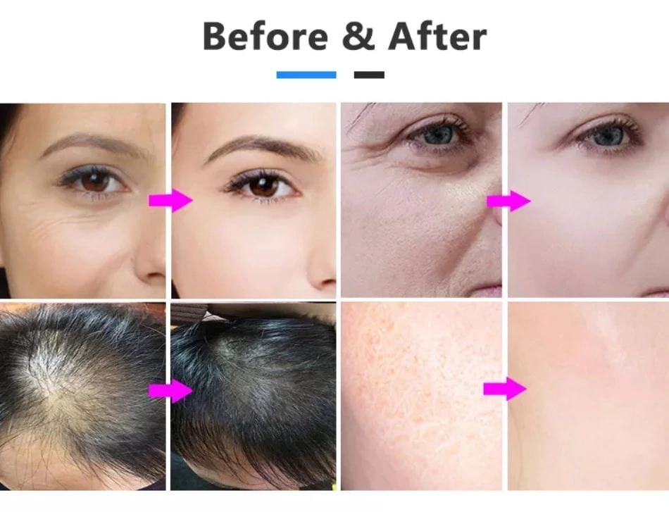 gun mesotherapy