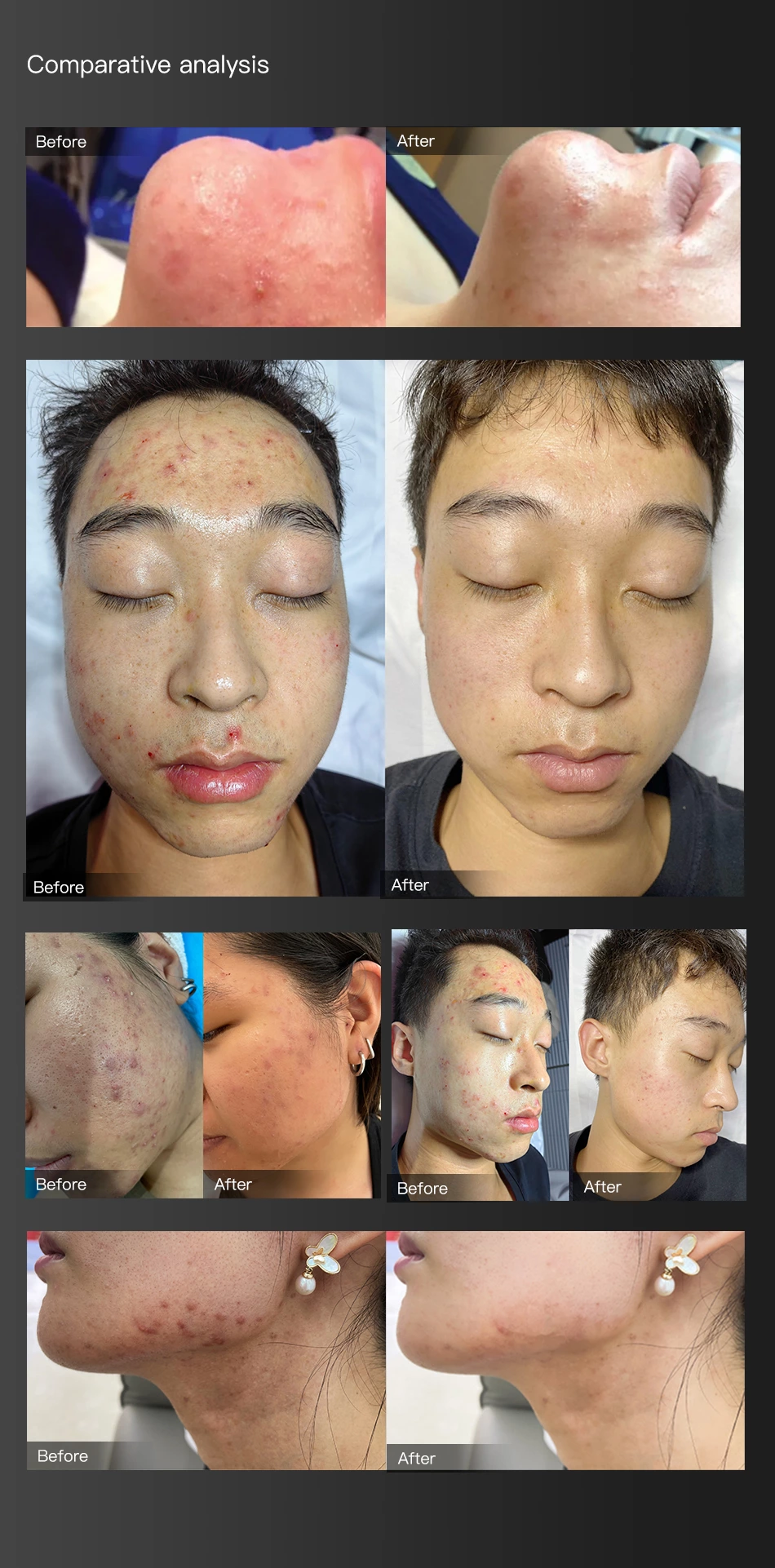 Treatment Acne Scar Face Serum