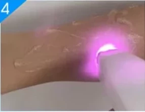 808 Diode Laser Hair Removal