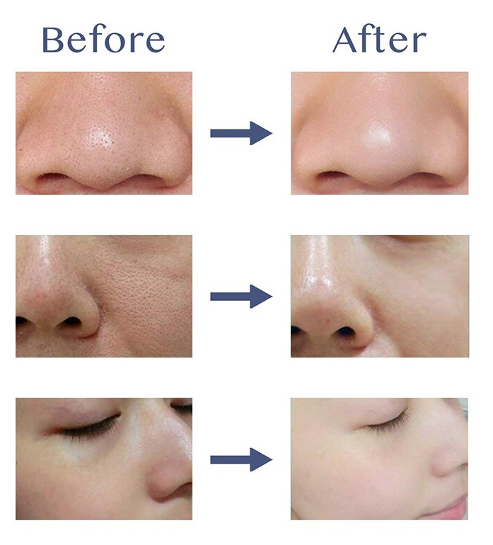 Professional Ultrasonic Skin Spatula Ibeier Technology