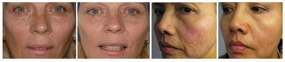 electric microneedle derma pen before and after