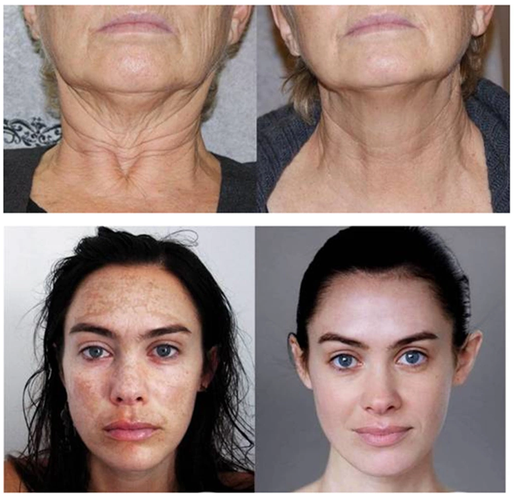 Before and after Mesotherapy Gun