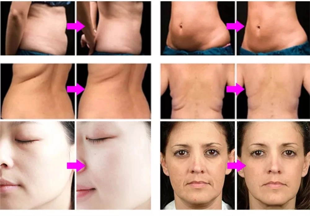 RF Body Contouring Machines Before and After