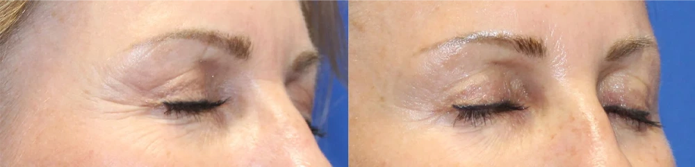 Before and after Secret Rf Microneedling