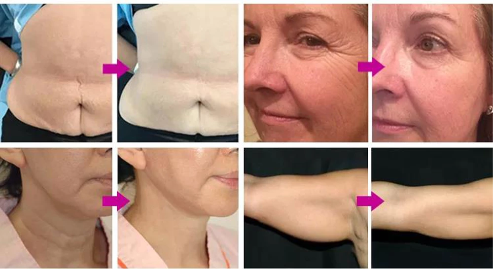 Hifu Body Slimming Machine Before and After