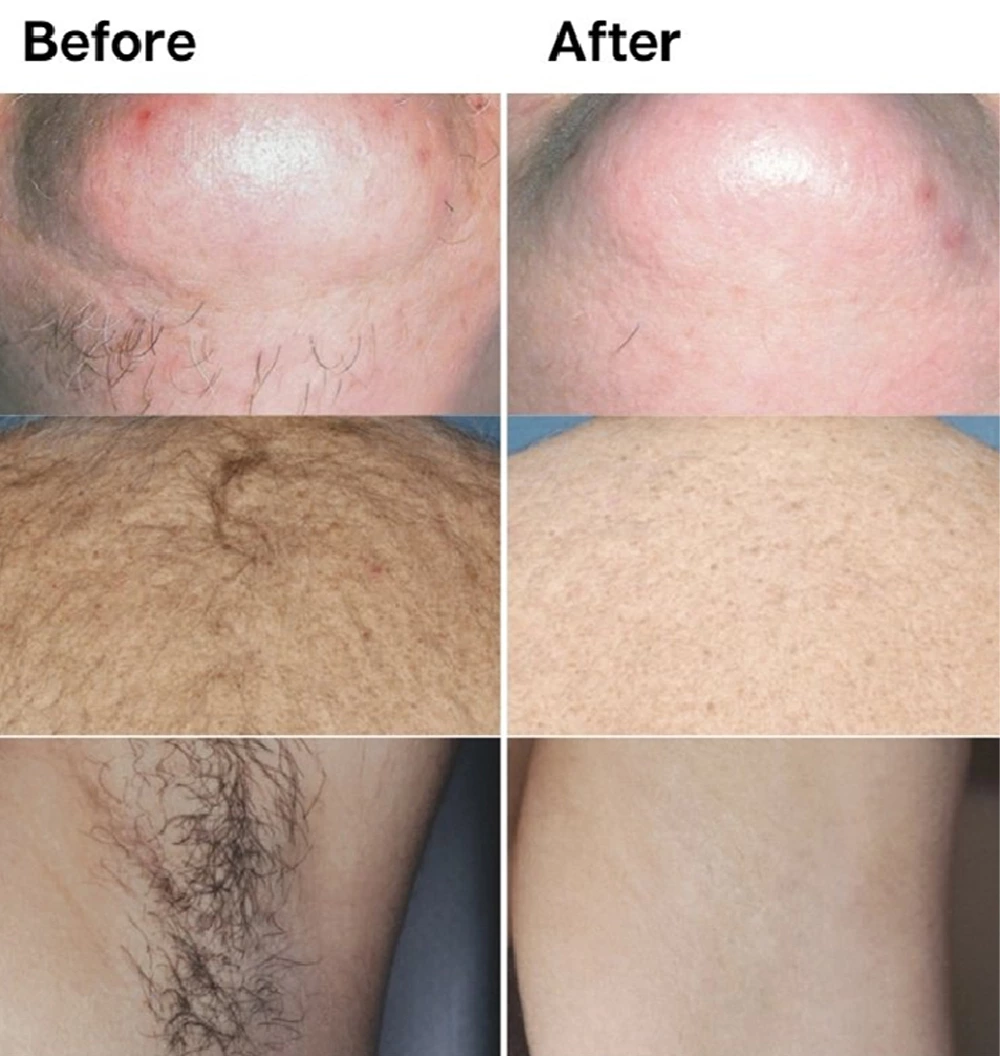 Portable 808 Diode Laser before and after