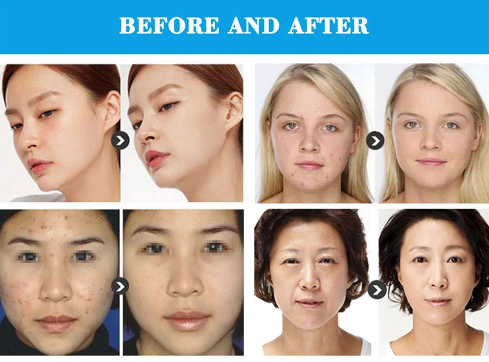 Before and after using Radiofrequency Face Machine