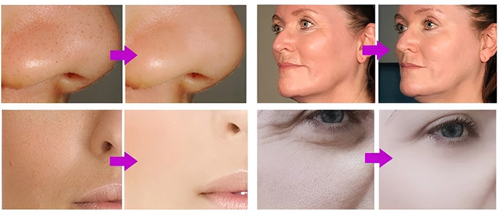 8 in 1 facial machine before and after