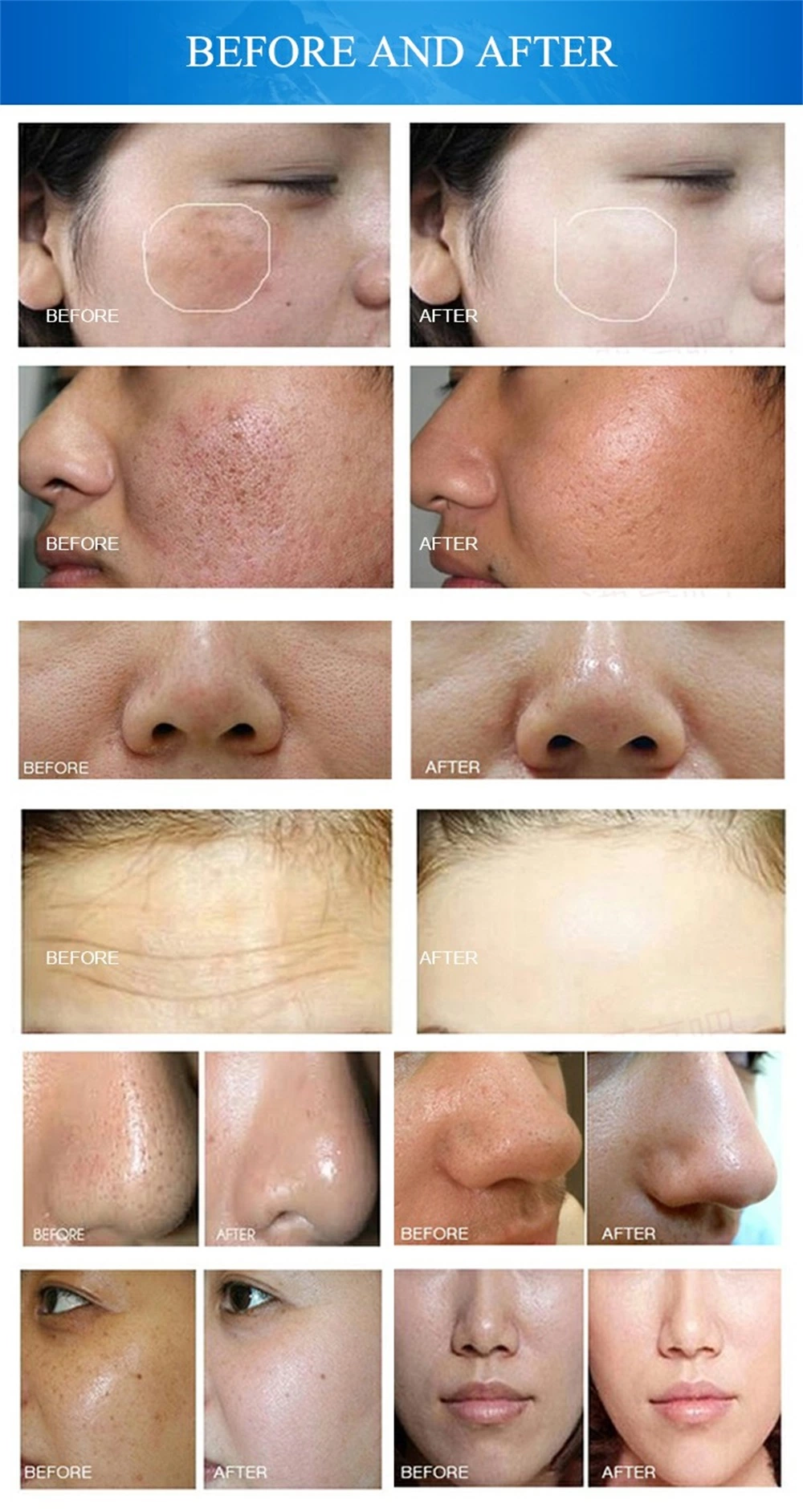 10 in 1 hydra facial machine before and after