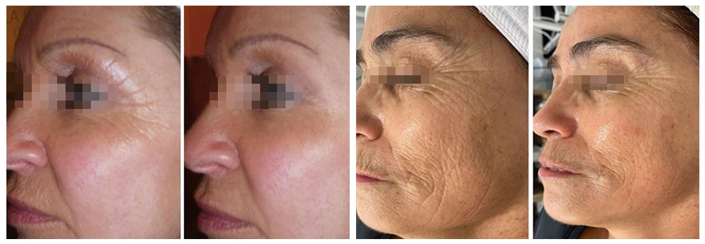 Before and After Electroporation Mesotherapy Machine