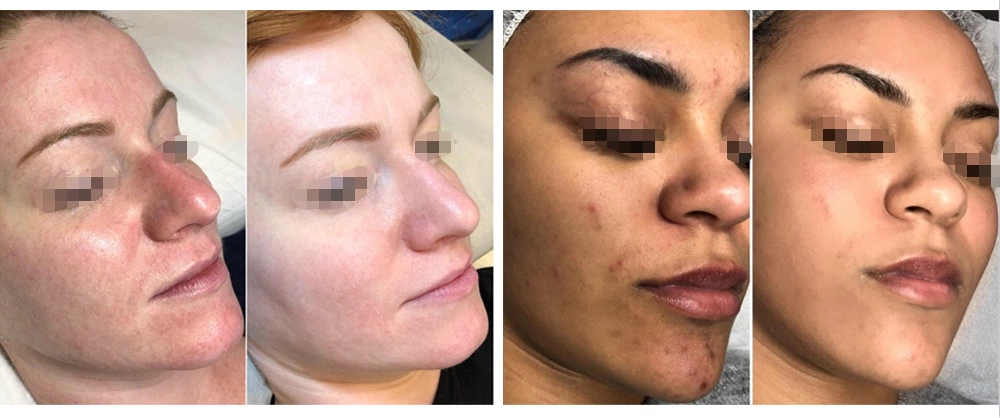 Before and after Mesomega Mesotherapy Gun