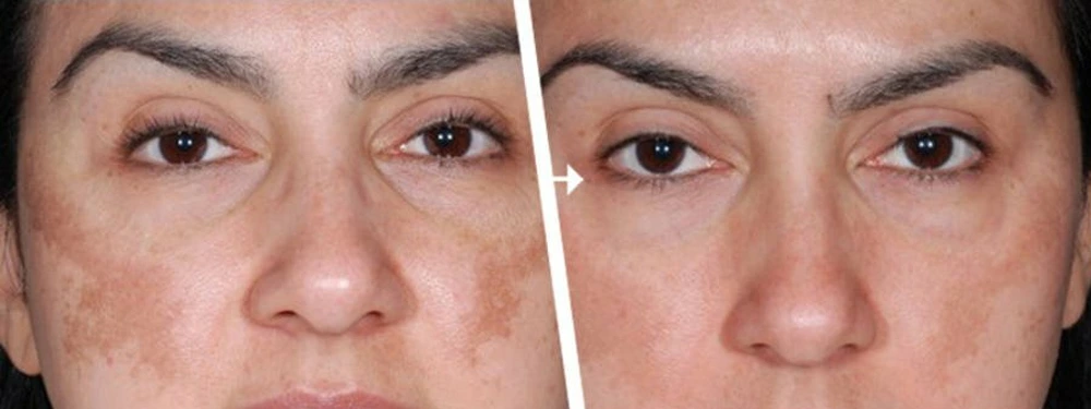 Professional Mesotherapy Gun Before and After