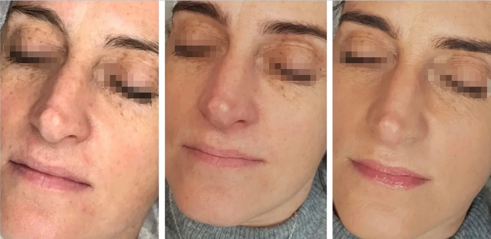 Fractional Rf Microneedle Machine Before and After