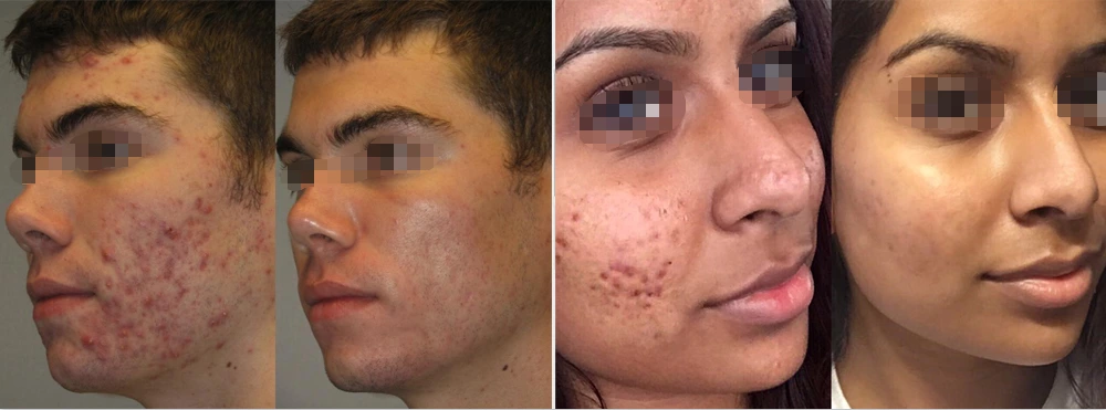Before and after Acne Face Serum