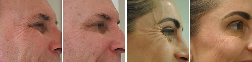 Anti Aging Eye Serum Before and After