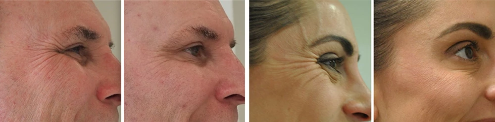Wrinkle Supreme Serum before and after use