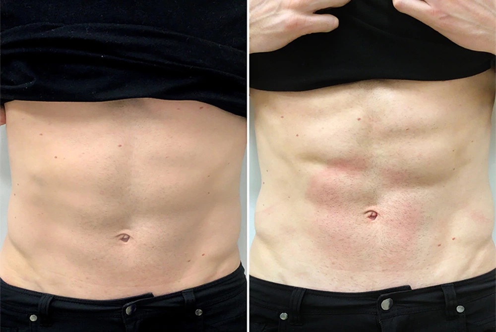 Before and after Emsculpt Neo Near Me