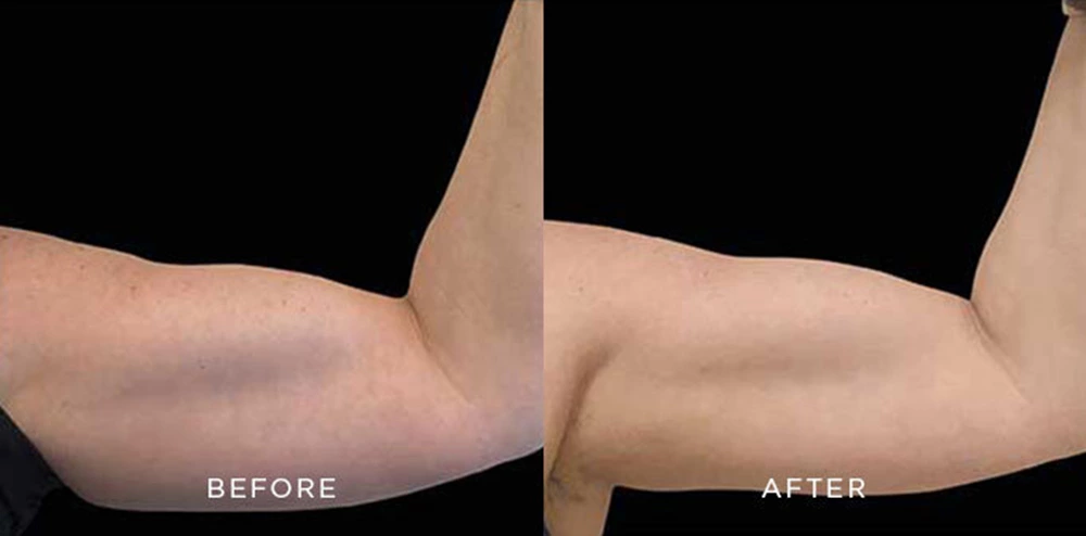 Emsculpt Neo Arms before and after