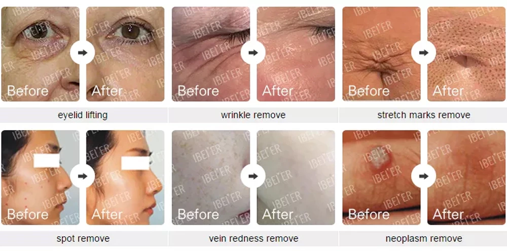 Before and after Dermavel Plasma Pen