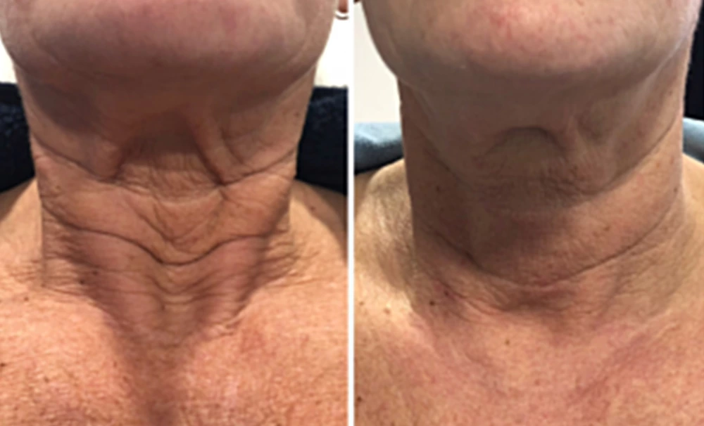 Dermavel Plasma Pen Before and After