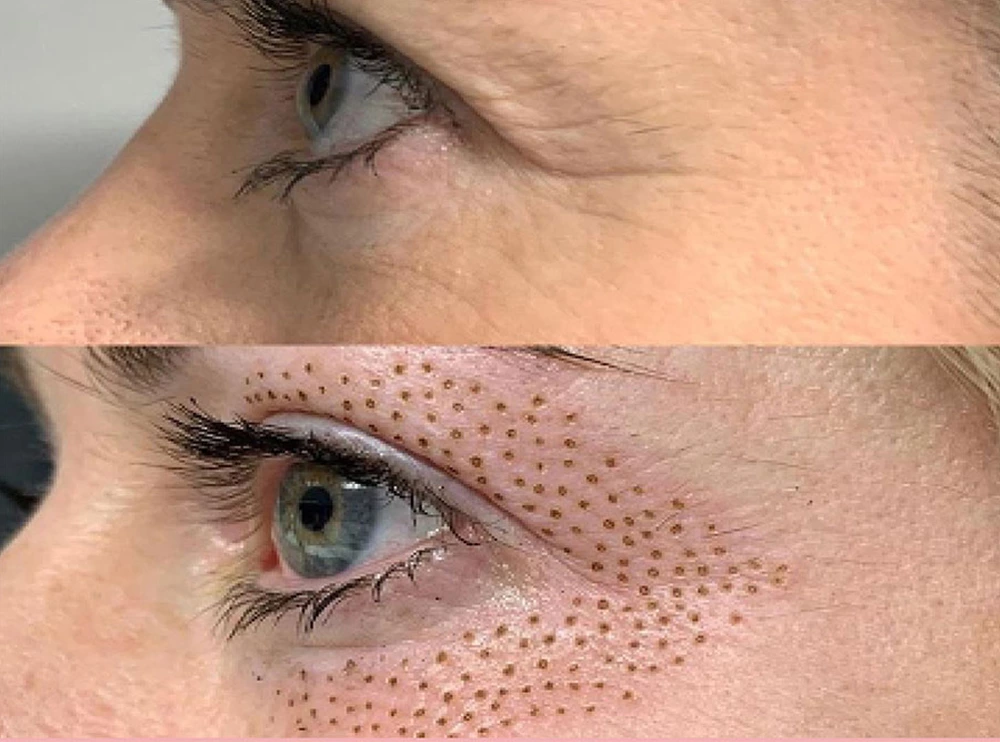 Before and after plasma pen under eye