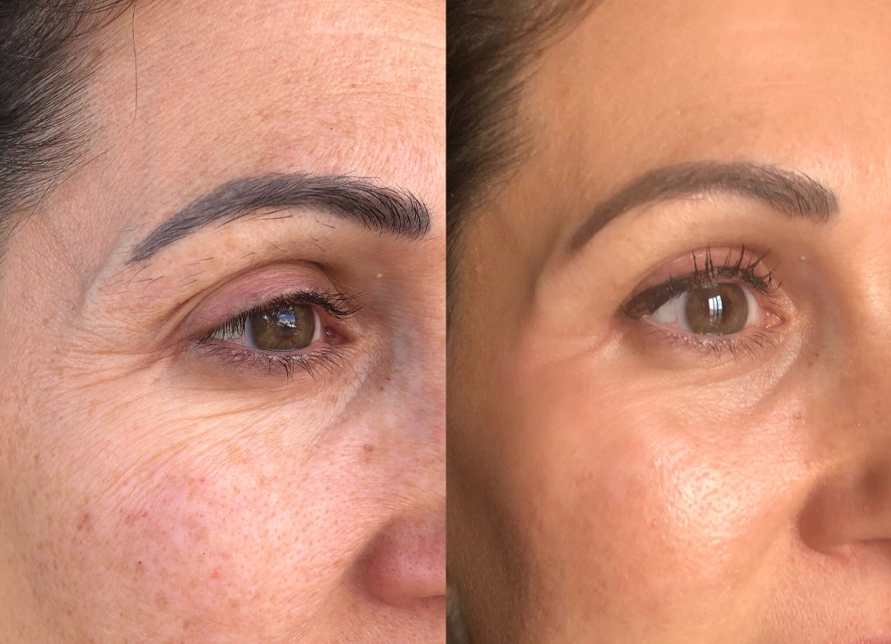 Plasma Fibroblast Pen Before and After