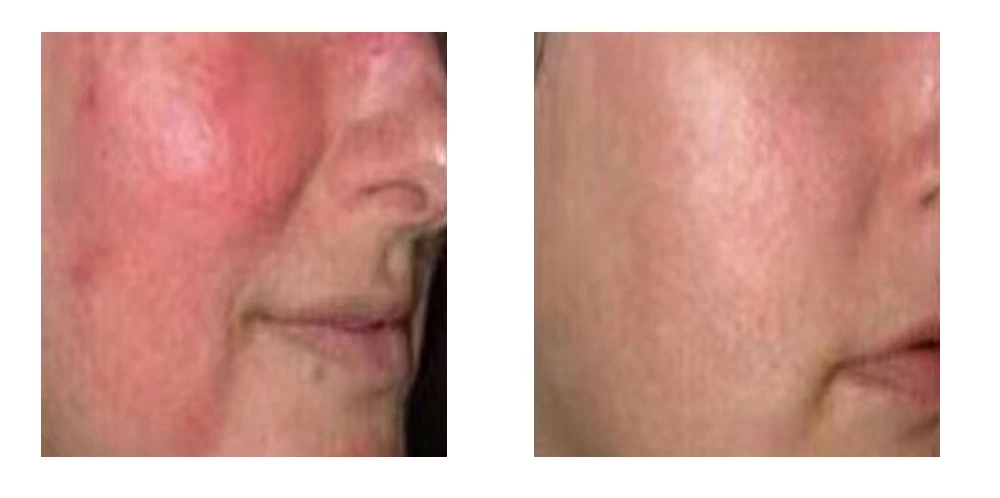 Plasma Ozone Therapy before and after