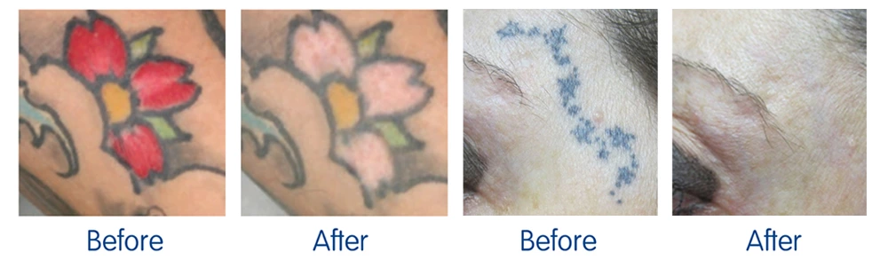 Laser Tattoo Removal Machine before and after