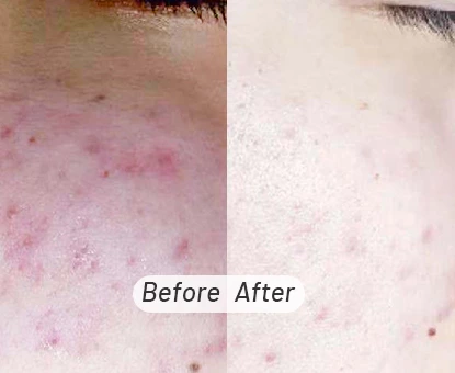 Plasma Pen Skin Tag Removal