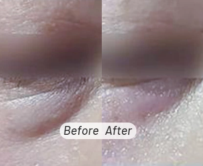 Plasma Pen Skin Tag Removal