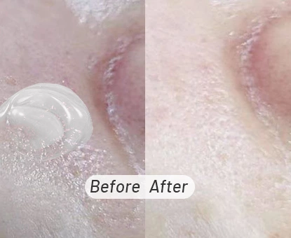 Plasma Pen Skin Tag Removal