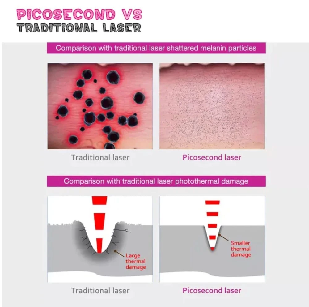 Picosecond Laser Tattoo Removal