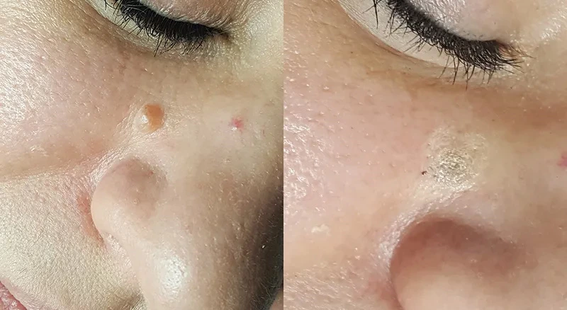 Plasma Pen Skin Tag Removal