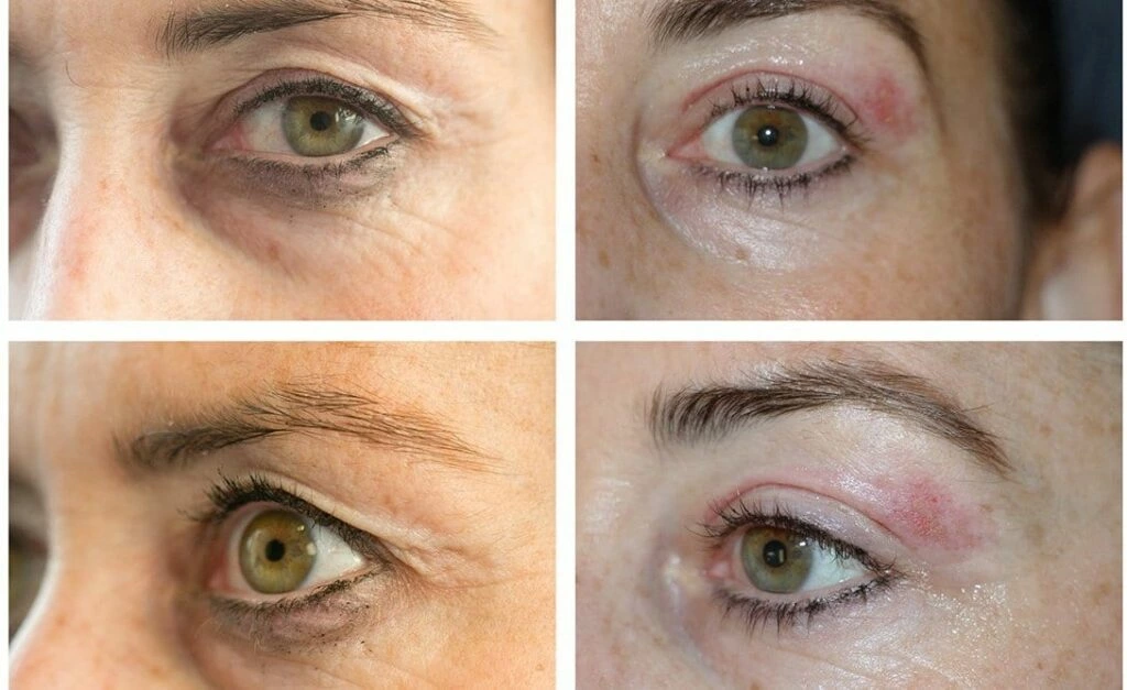 Plasma Pen Upper Eyelid