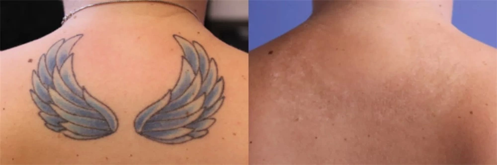 Tattoo Removal Laser Cost