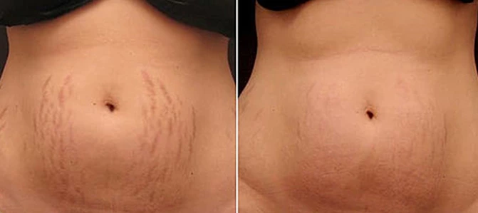 Plasma pen treatment before and after