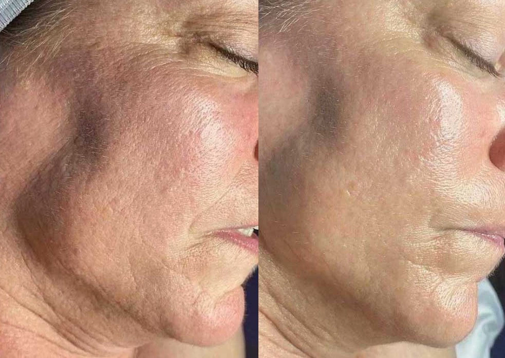 Hydrafacial machine before and after